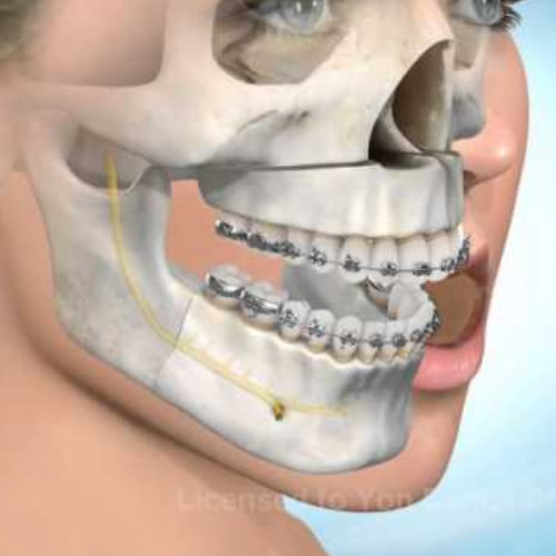 正顎手術完整分析介紹 - 手術前必看推薦完整攻略
