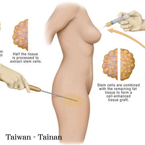 台南自體脂肪移植手術權威醫師推薦