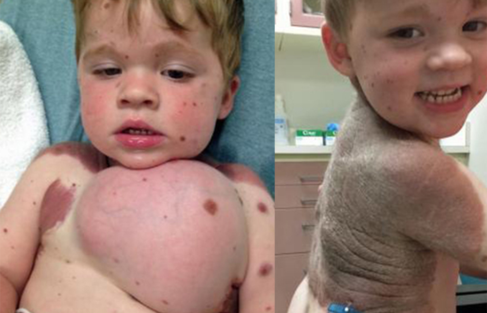 4歲男孩為治巨痣怪病 動26次「隆乳手術」