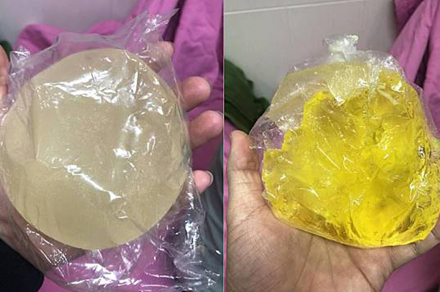 越南女星搭機假奶爆裂 矽膠變質黃色硬塊