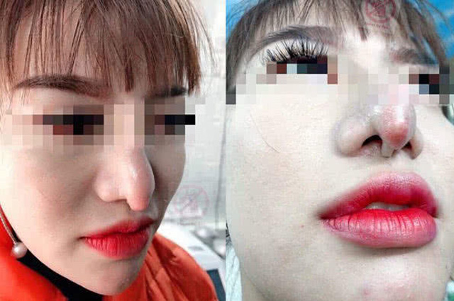 越南女孩存錢整形 竟隆鼻失敗變「畸形鼻」