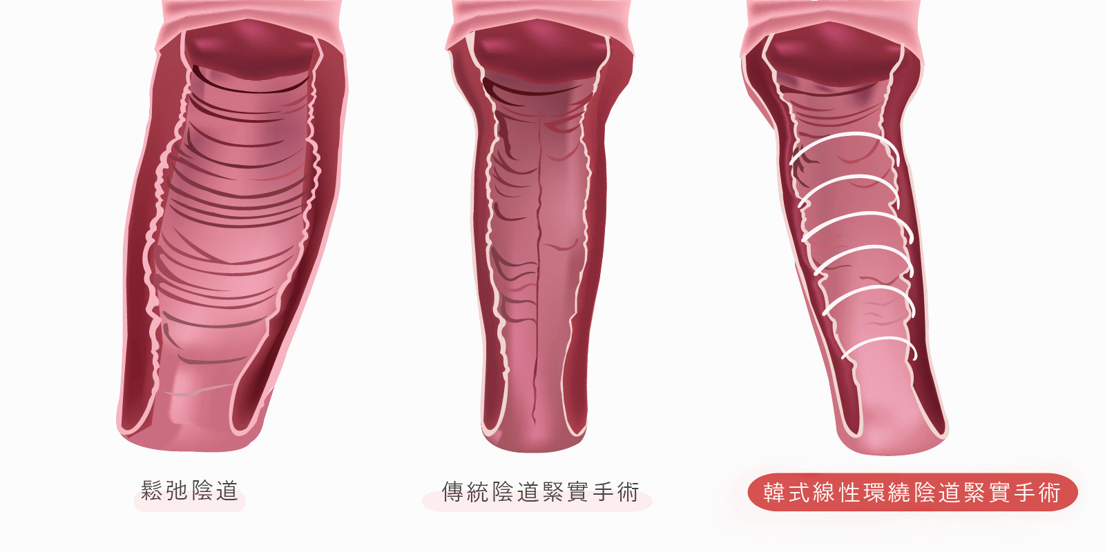 韓式全層線性環繞陰道緊實縮緊手術與傳統手術差異