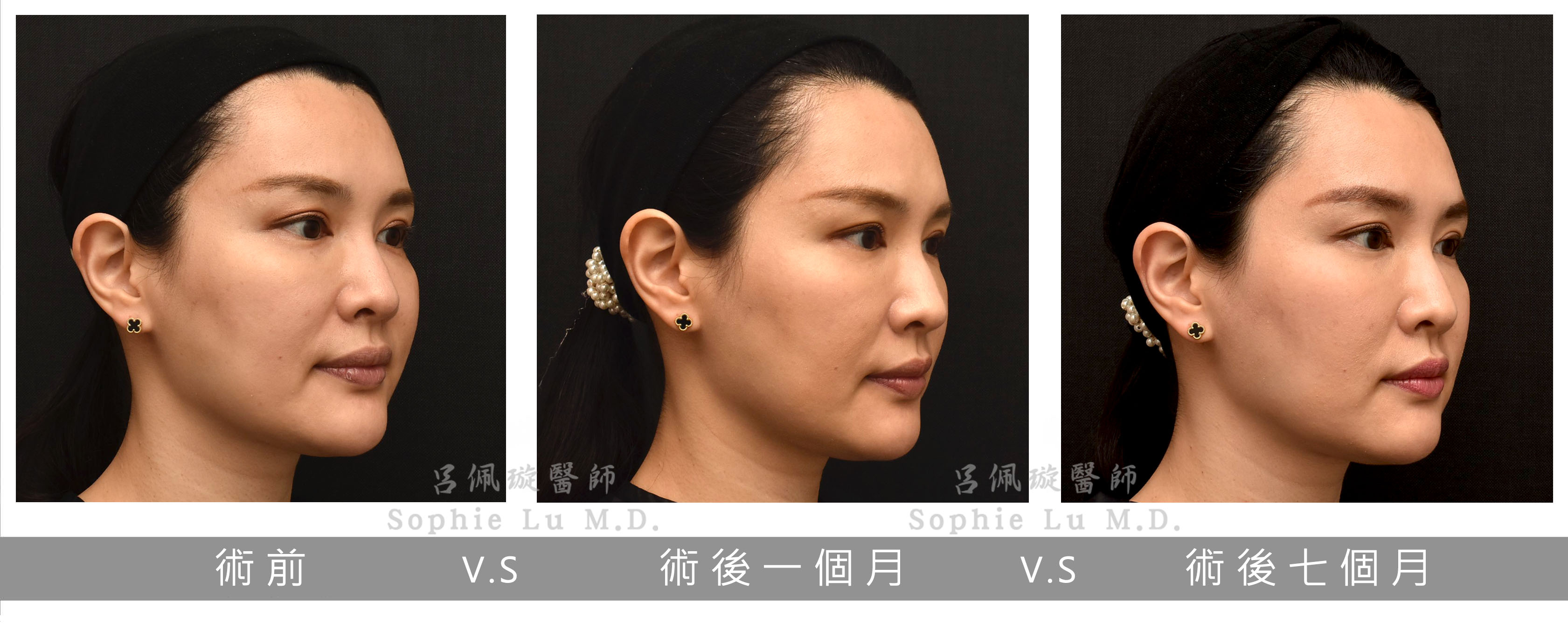 呂佩璇醫師治療案例 全臉與頸部 鳳凰電波900發