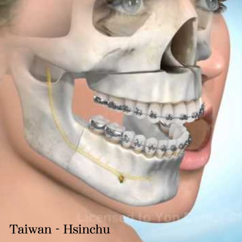 新竹正顎手術權威醫師推薦