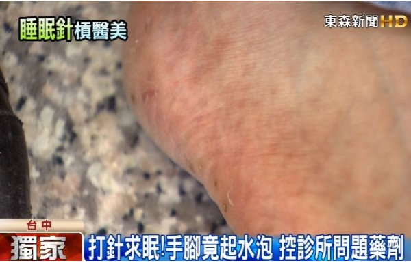 打睡眠針竟手腳長泡 控醫美診所問題針劑