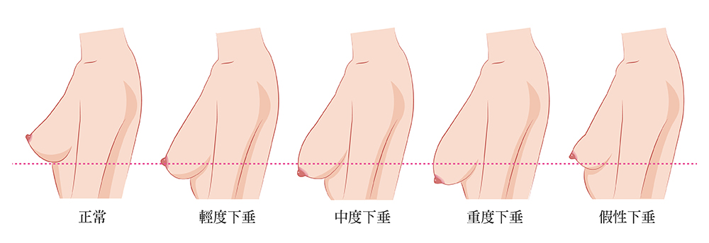 什麼人需要做隆乳手術？ 