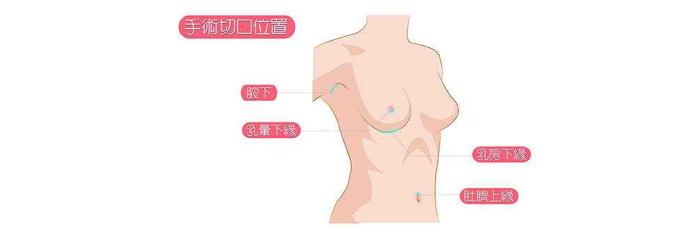 隆乳手術的切口位置