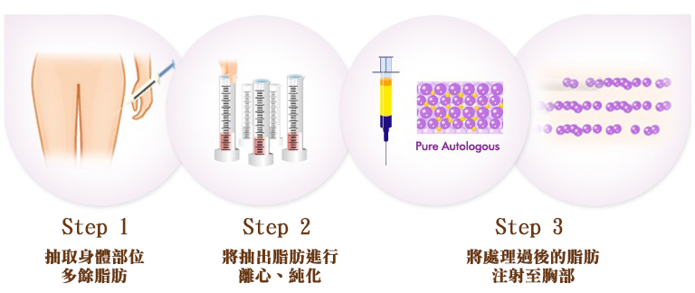 自體脂肪隆乳手術流程步驟