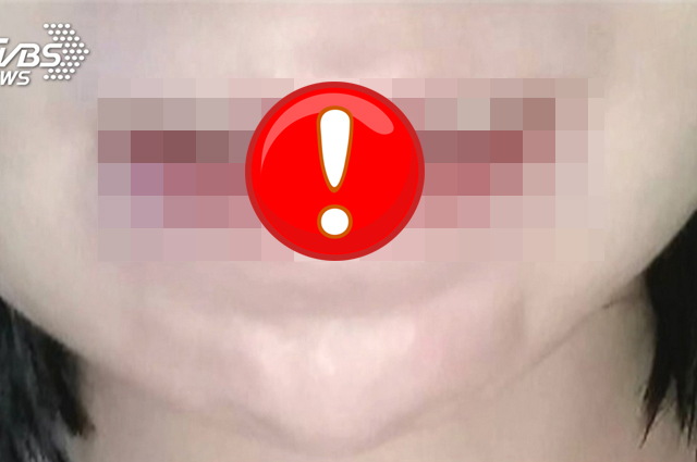 港女控整微笑唇剩唇珠 診所：未配合衛教