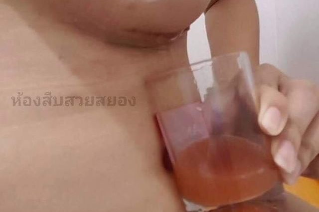 假奶破流出杯杯膿湯 慘！她隆乳失敗還失業