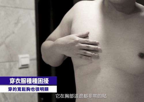 男性女乳症抽脂手術小林抽脂手術心得日記分享