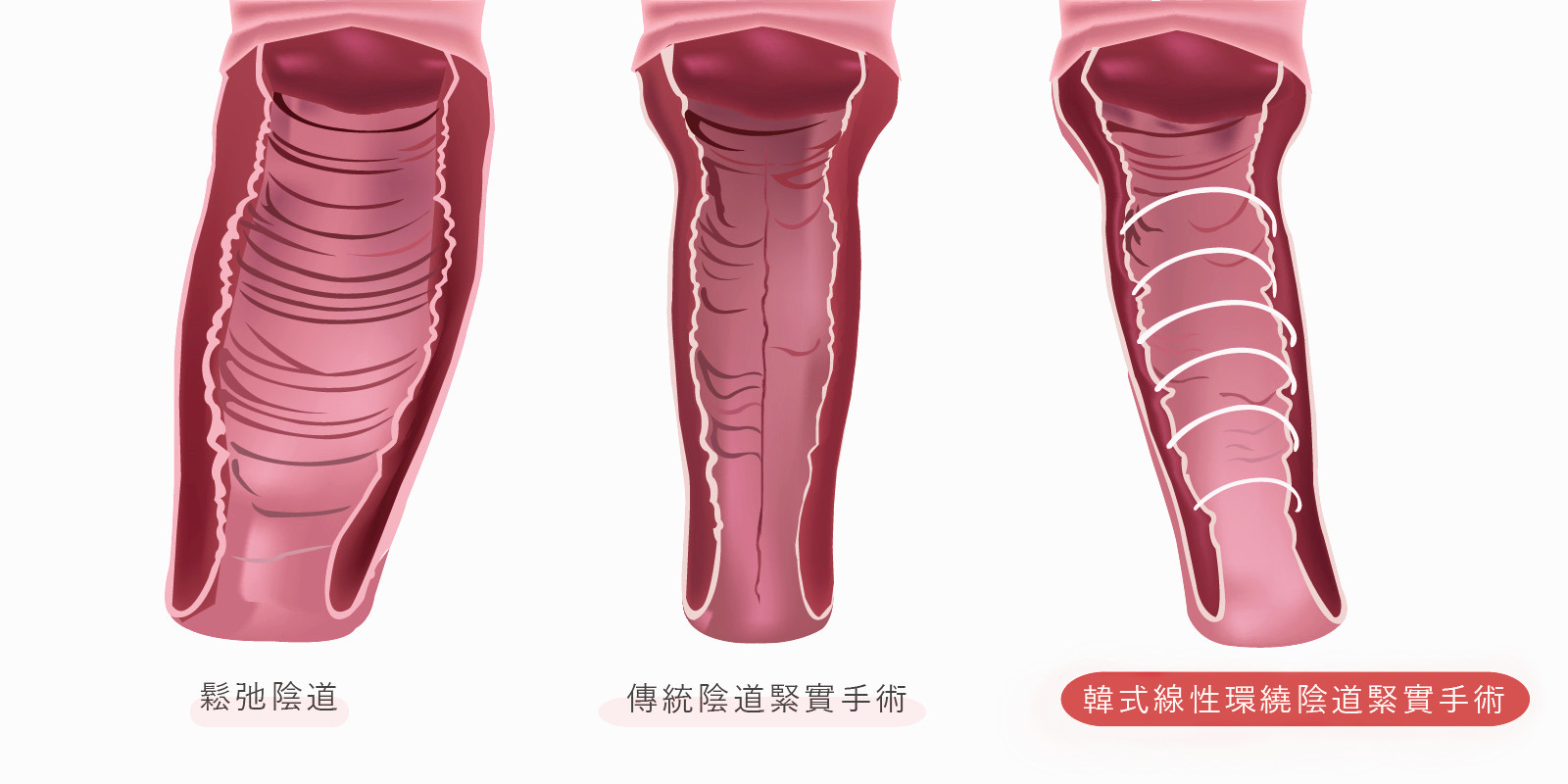 私密處整形權威唐遠霞,韓式線性環繞陰道緊實手術