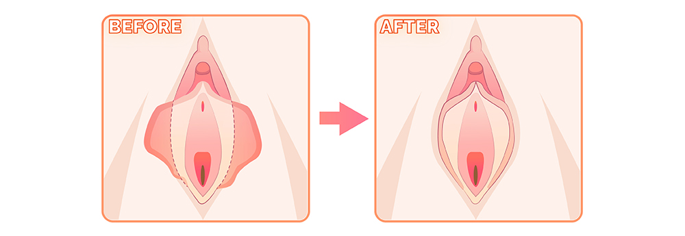 小陰唇整形手術前後差異比對