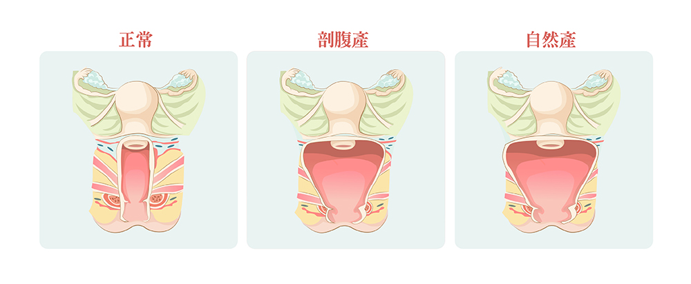 陰道鬆弛嚴重程度示意圖