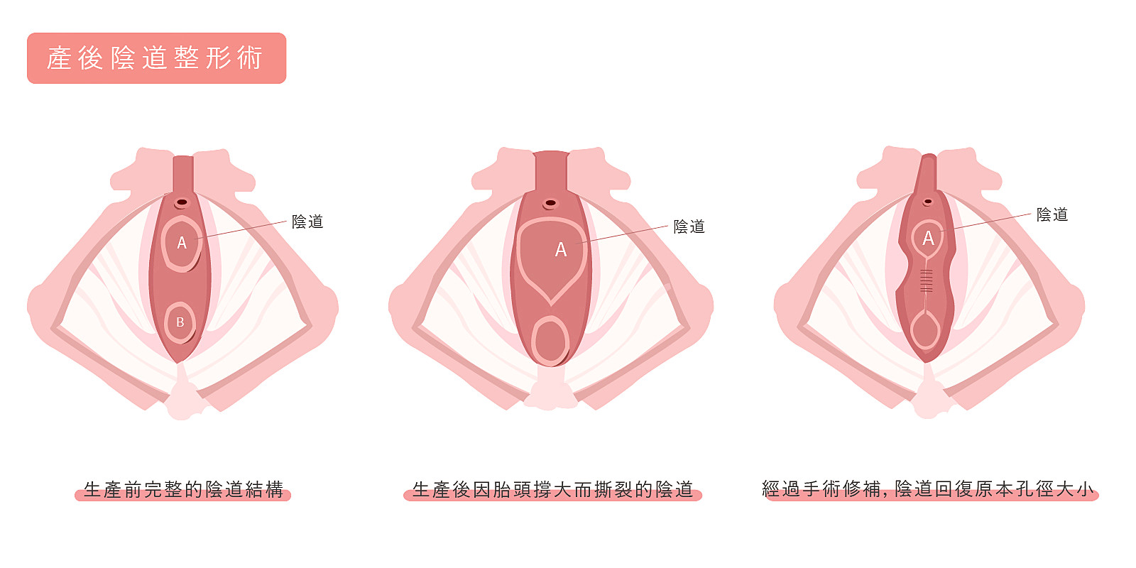 產後陰道鬆弛症狀示意圖