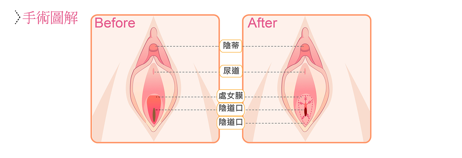 處女膜手術模擬