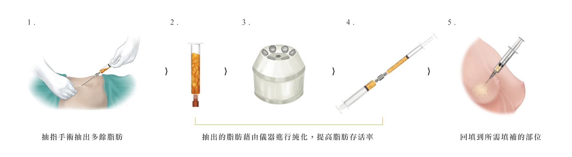 自體脂肪隆乳傷口