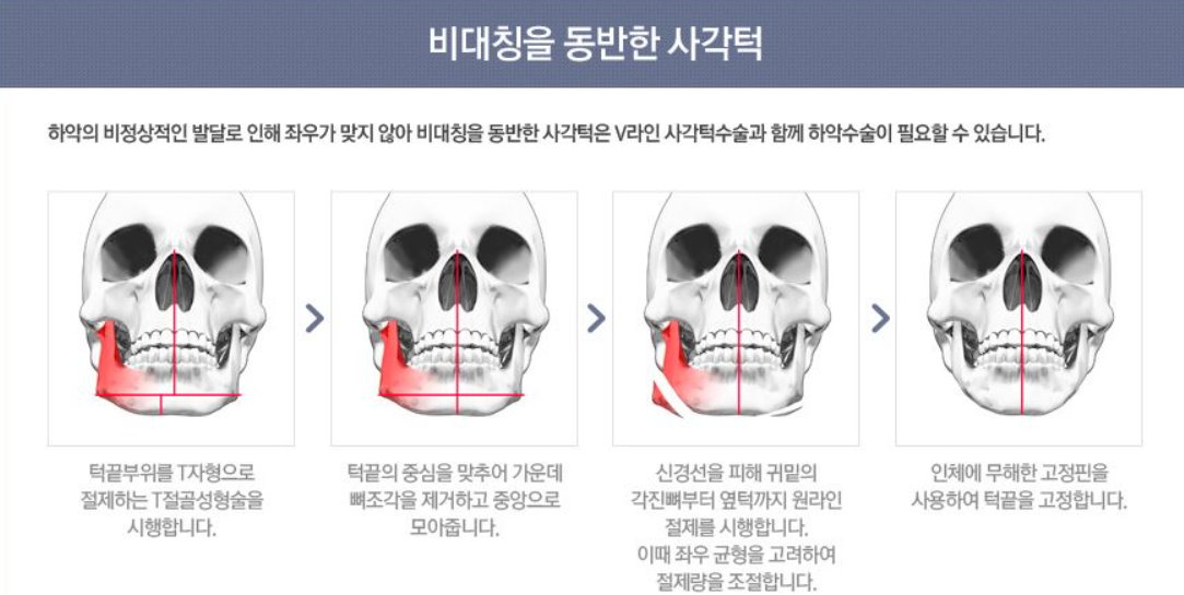 台中下巴截骨手術