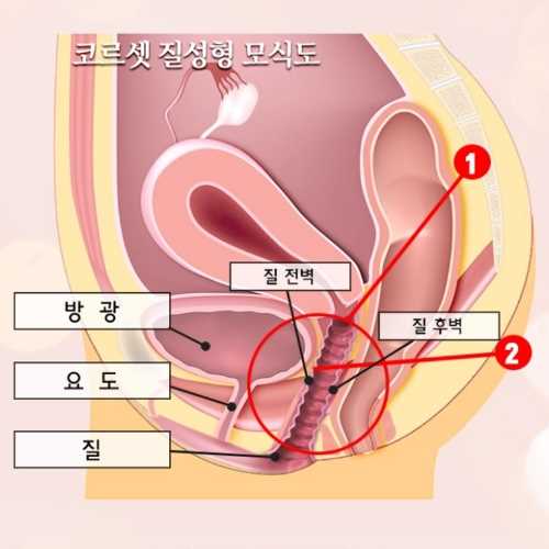 高雄女性陰道緊實手術權威醫師推薦